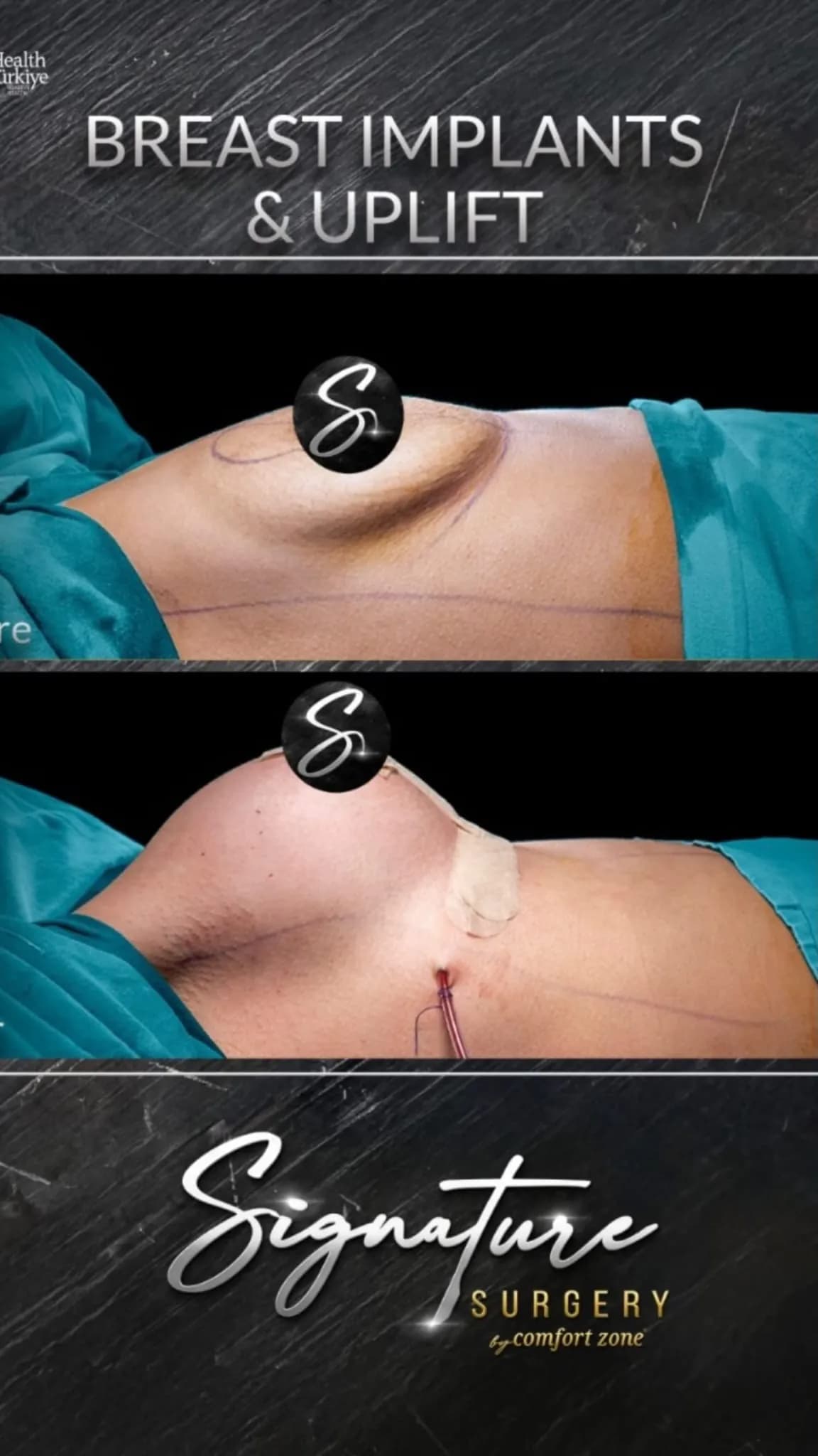 Implanty i lifting piersi, przed i po, Signature Surgery by Comfort Zone