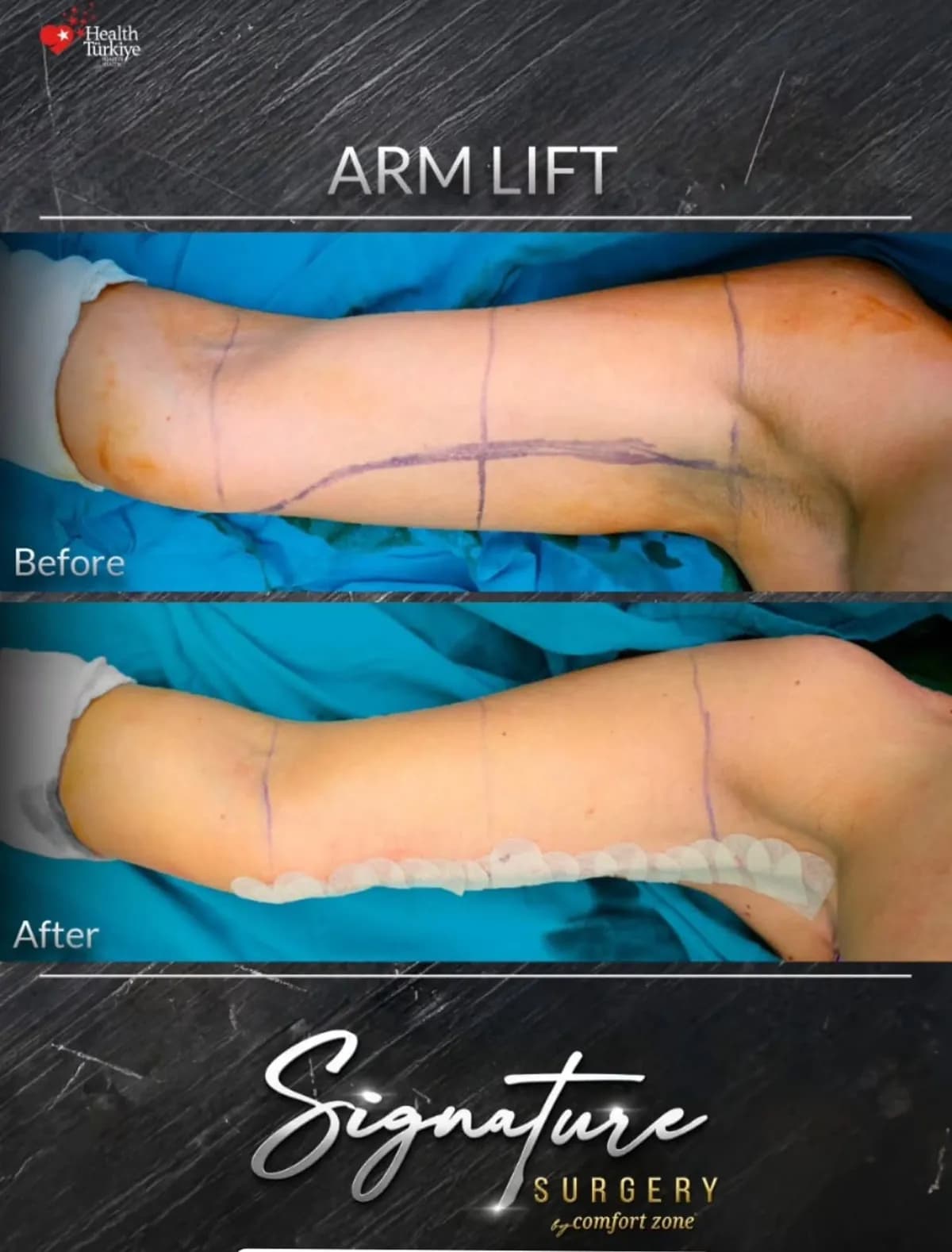 Lifting ramion, przed i po, Signature Surgery by Comfort Zone