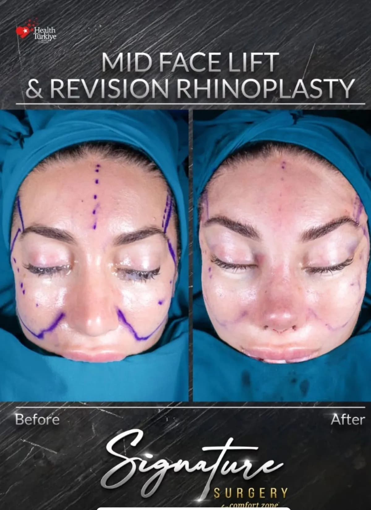 Lifting środkowej części twarzy i rynoplastyka rewizyjna, przed i po, Signature Surgery by Comfort Zone