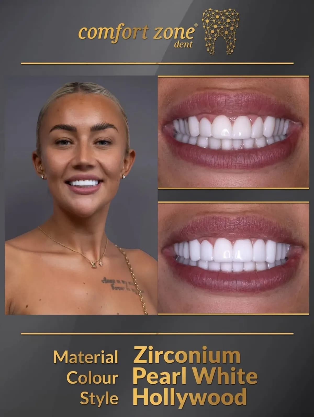 Metamorfoza uśmiechu, cyrkon, odcień Pearl White, styl Hollywood, przed i po, Comfort Zone Dent