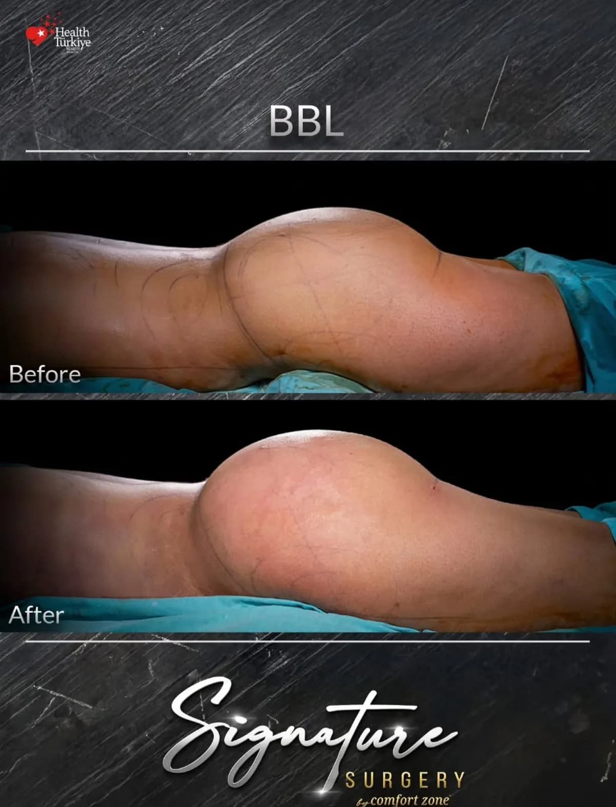 BBL, widok z boku, przed i po, Signature Surgery by Comfort Zone