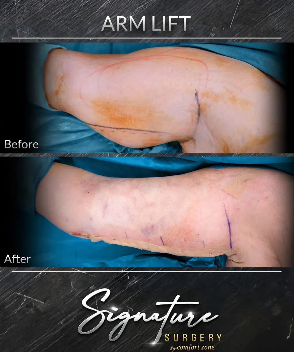 Lifting ramion, przed i po, Signature Surgery by Comfort Zone