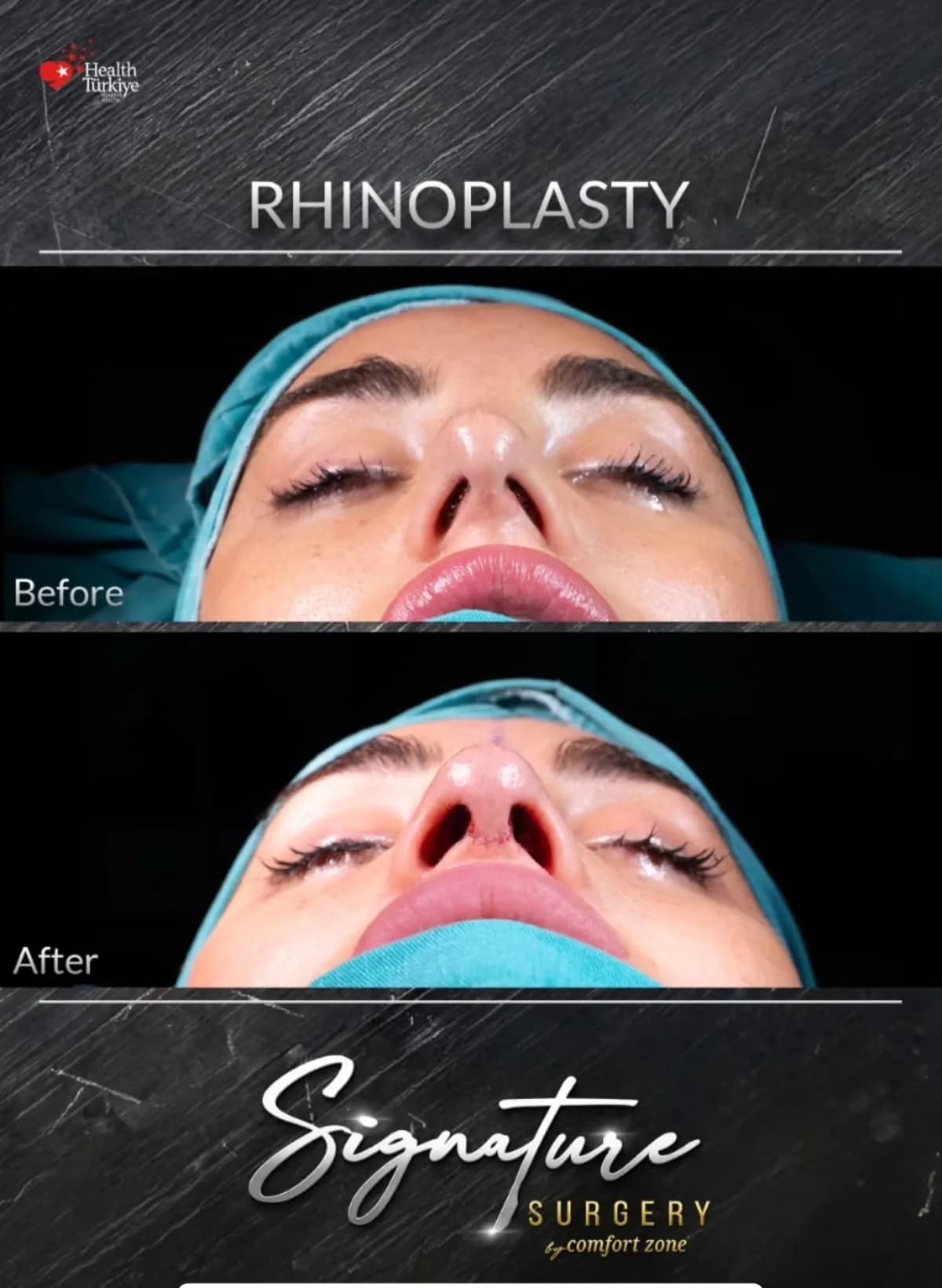 Rynoplastyka, przed i po, Signature Surgery by Comfort Zone