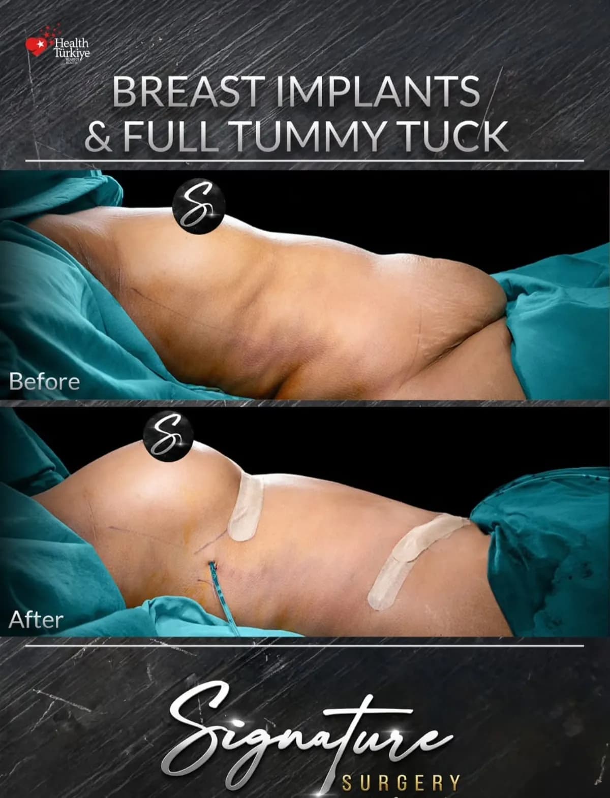 Implanty piersi i pełna plastyka brzucha, przed i po, Signature Surgery by Comfort Zone