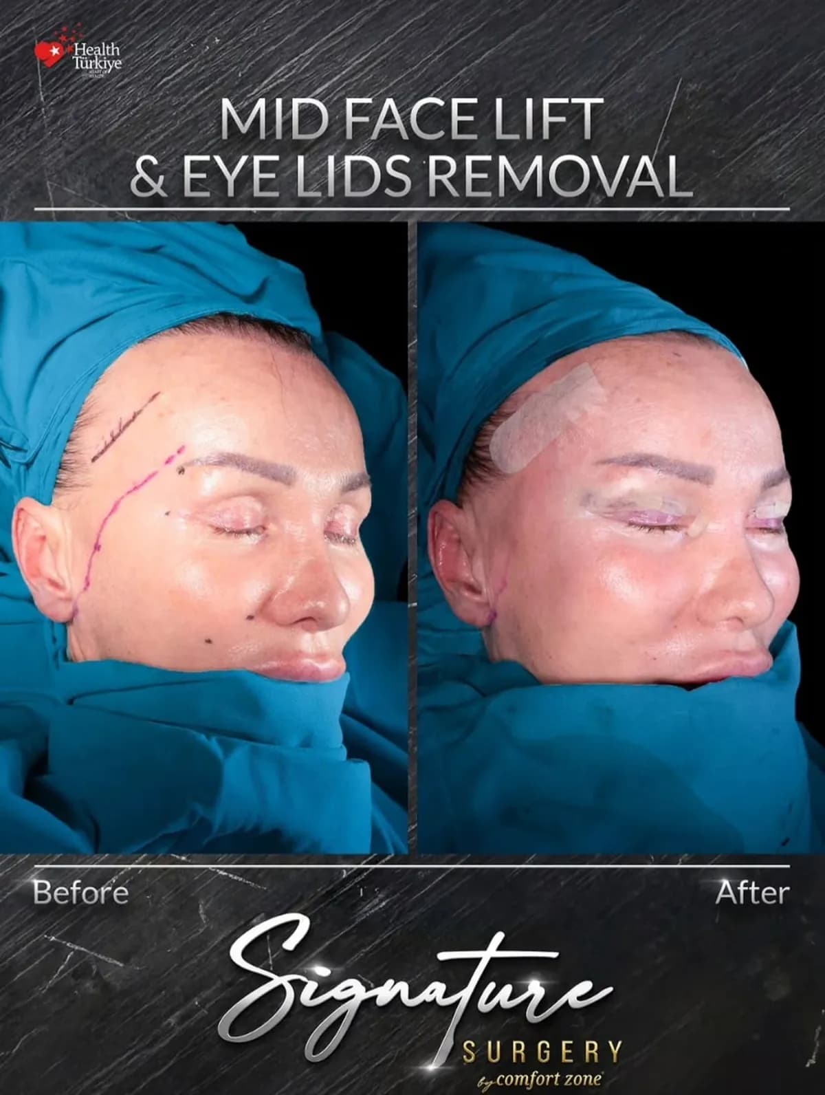 Lifting środkowej części twarzy i korekta powiek, przed i po, Signature Surgery by Comfort Zone