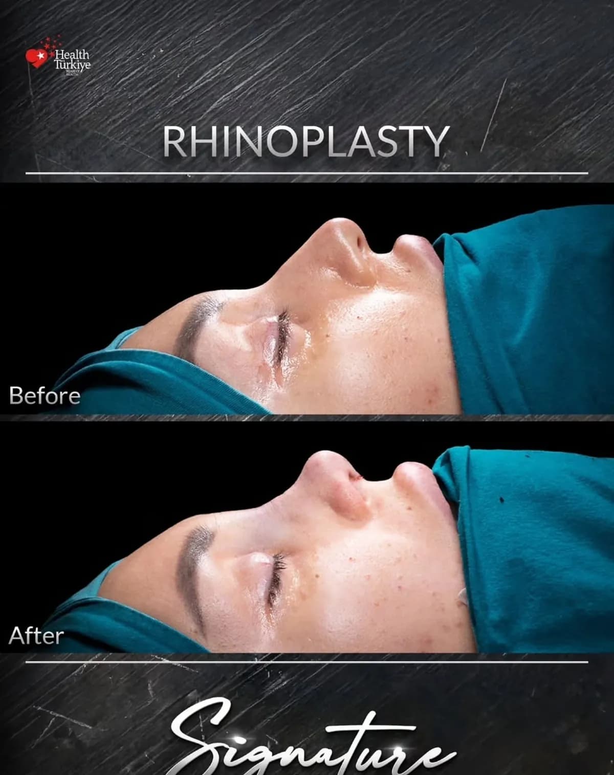Rynoplastyka, widok z profilu, przed i po, Signature Surgery by Comfort Zone