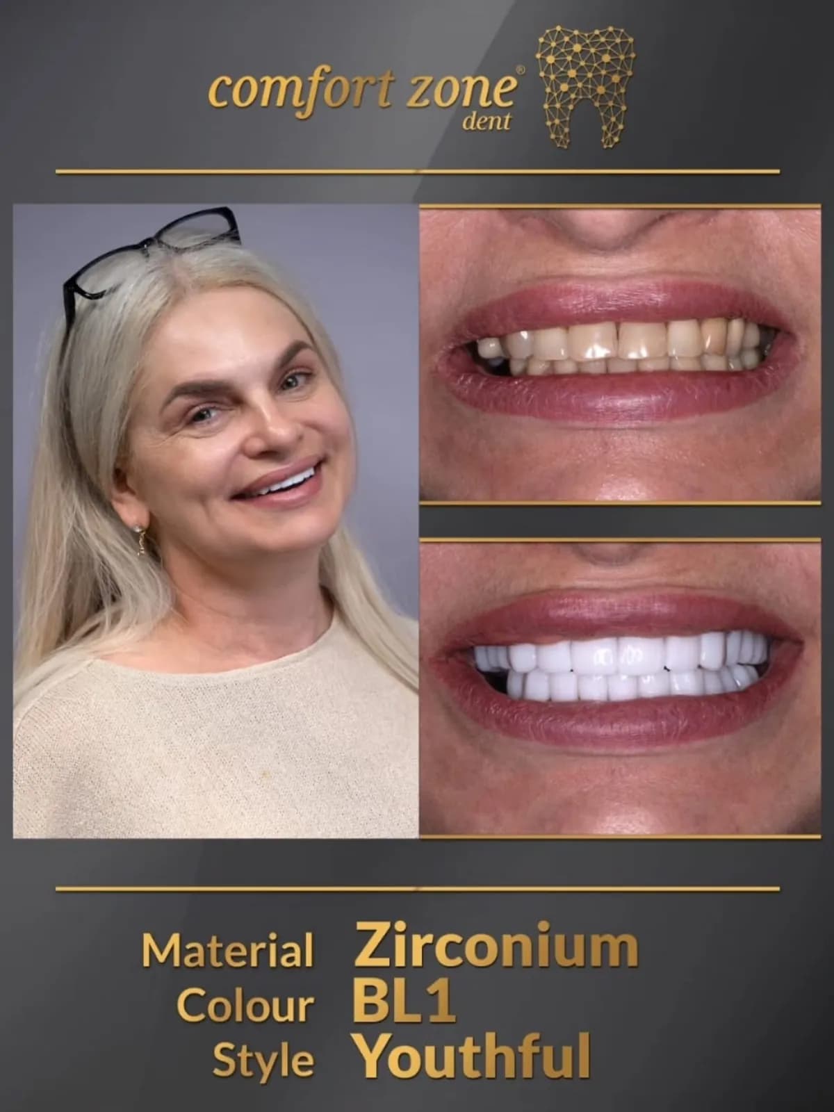 Metamorfoza uśmiechu, cyrkon, odcień BL1, styl młodzieńczy, przed i po, Comfort Zone Dent
