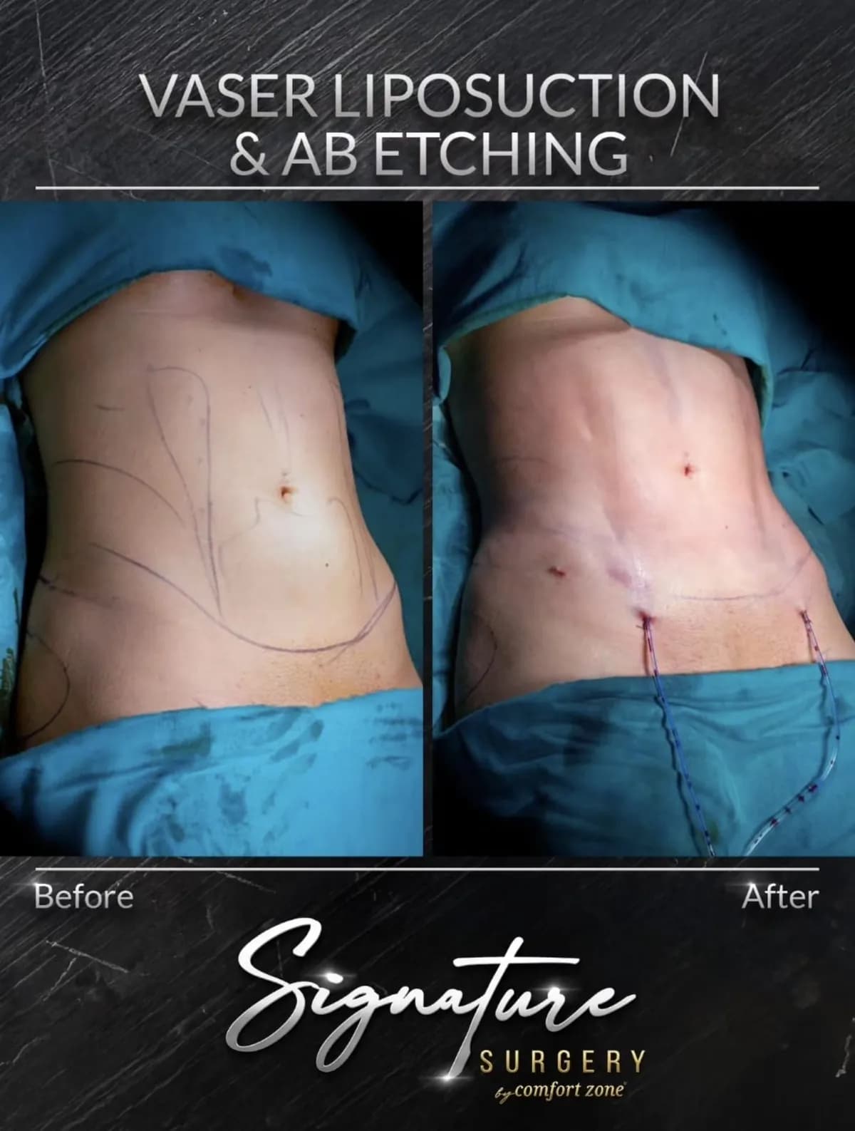 Liposukcja Vaser i ab etching, przed i po, Signature Surgery by Comfort Zone