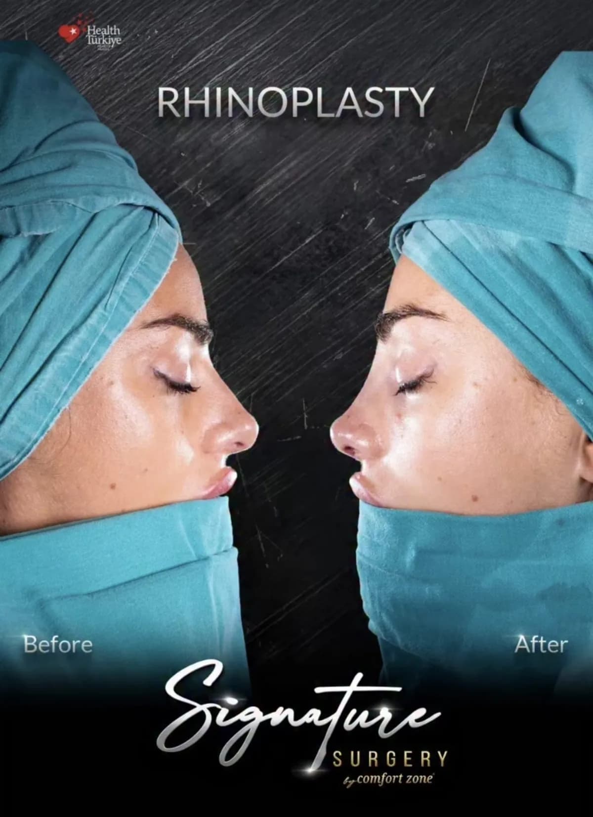 Rynoplastyka, przed i po, Signature Surgery by Comfort Zone