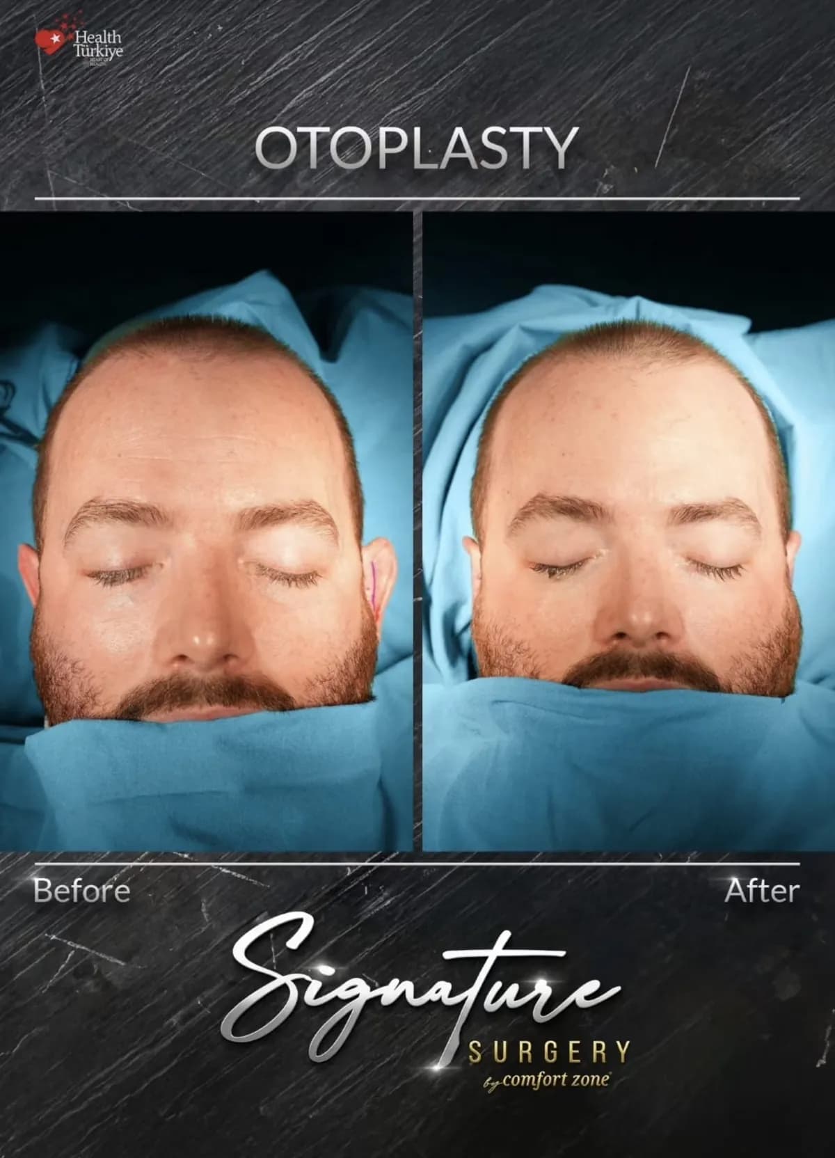 Otoplastyka, pacjent, przed i po, Signature Surgery by Comfort Zone