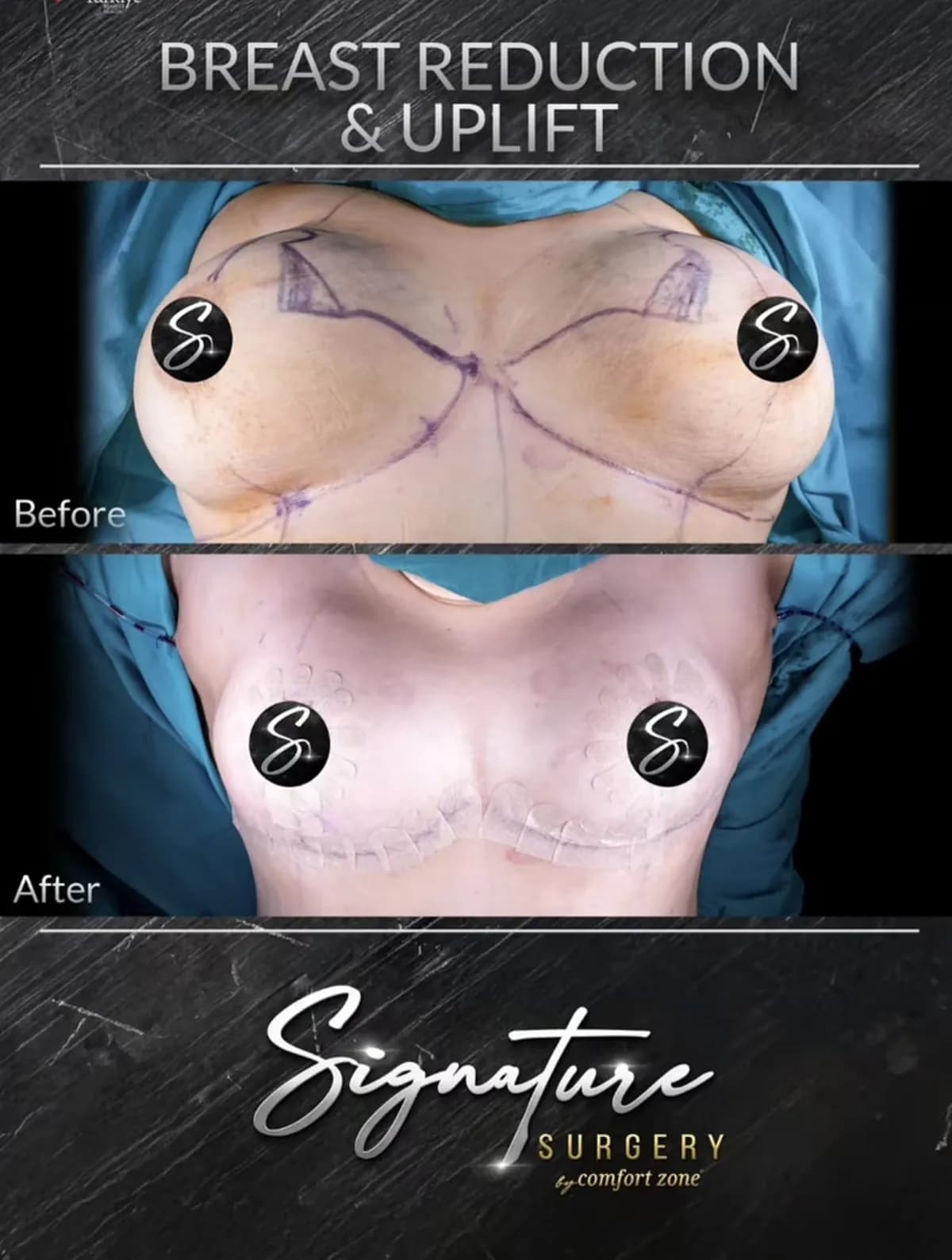 Redukcja i lifting piersi, przed i po, Signature Surgery by Comfort Zone