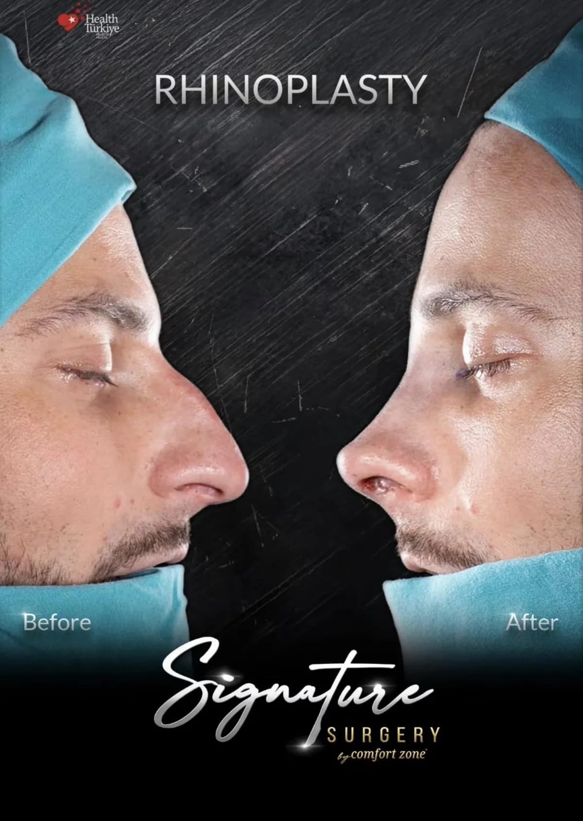 Rynoplastyka, pacjent, przed i po, Signature Surgery by Comfort Zone