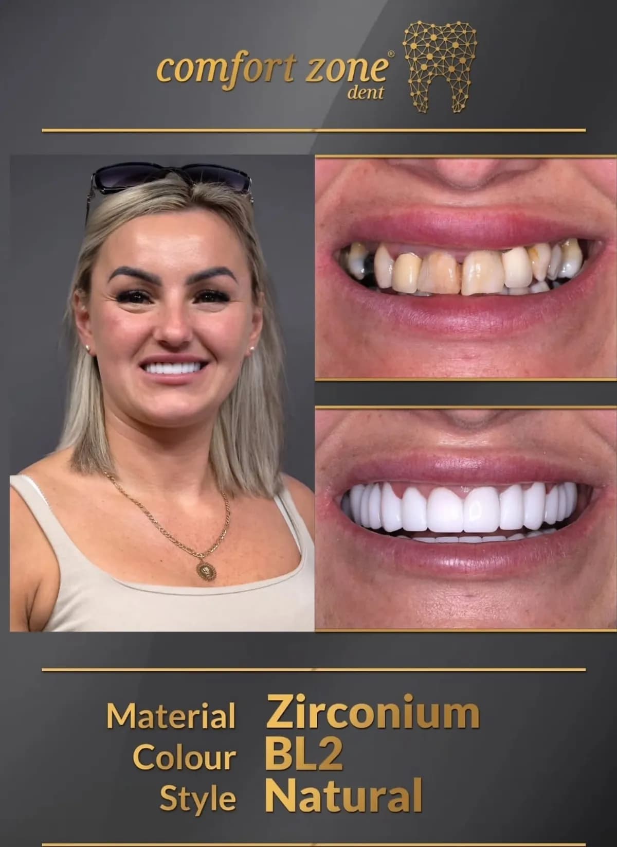 Metamorfoza uśmiechu, cyrkon, odcień BL2, styl naturalny, przed i po, Comfort Zone Dent
