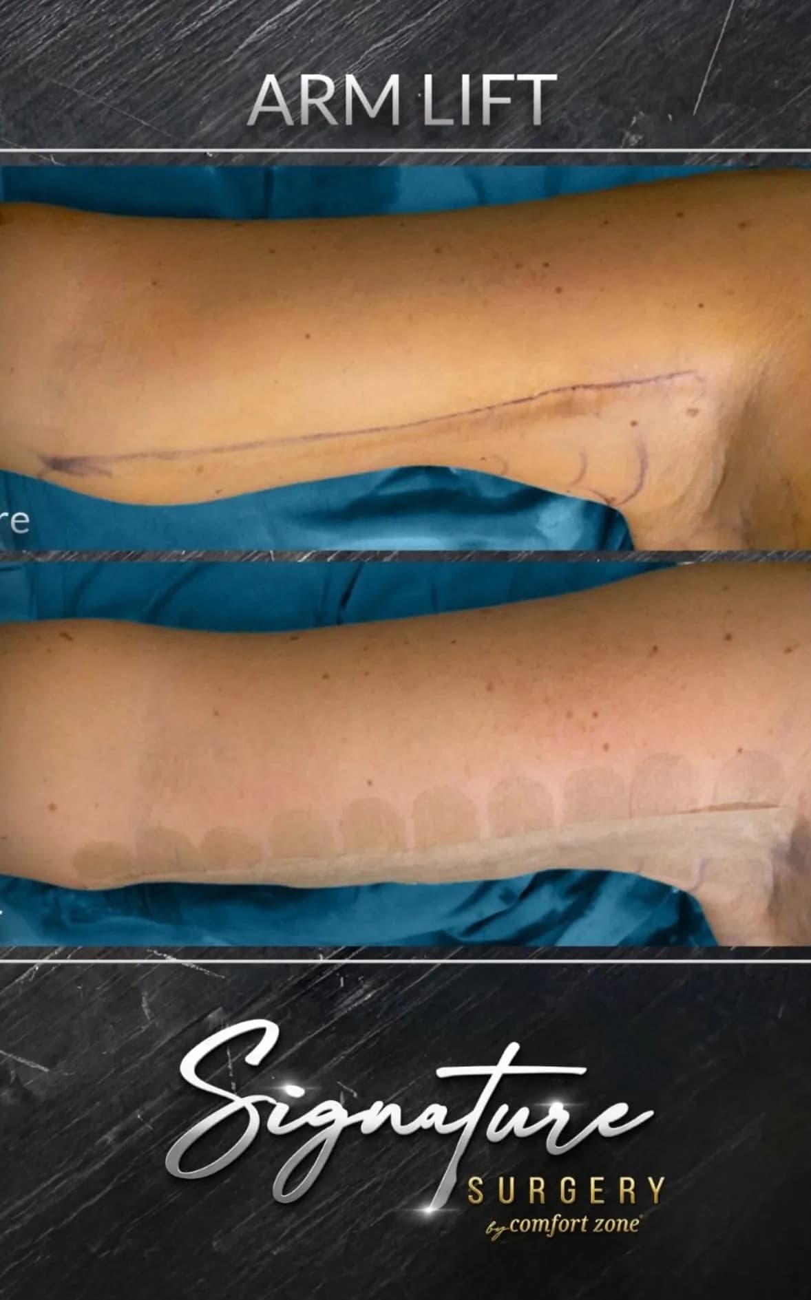 Lifting ramion, przed i po, Signature Surgery by Comfort Zone